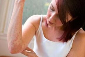 Allergien gegen Parasiten