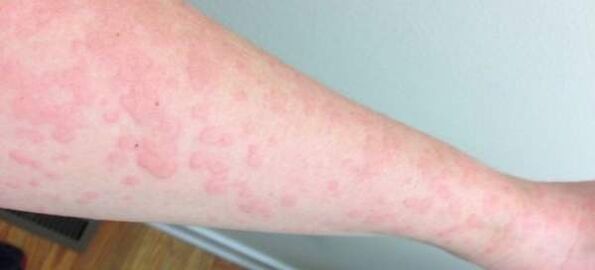 Hautallergien sind ein Zeichen für das Vorhandensein von Parasiten im Körper.